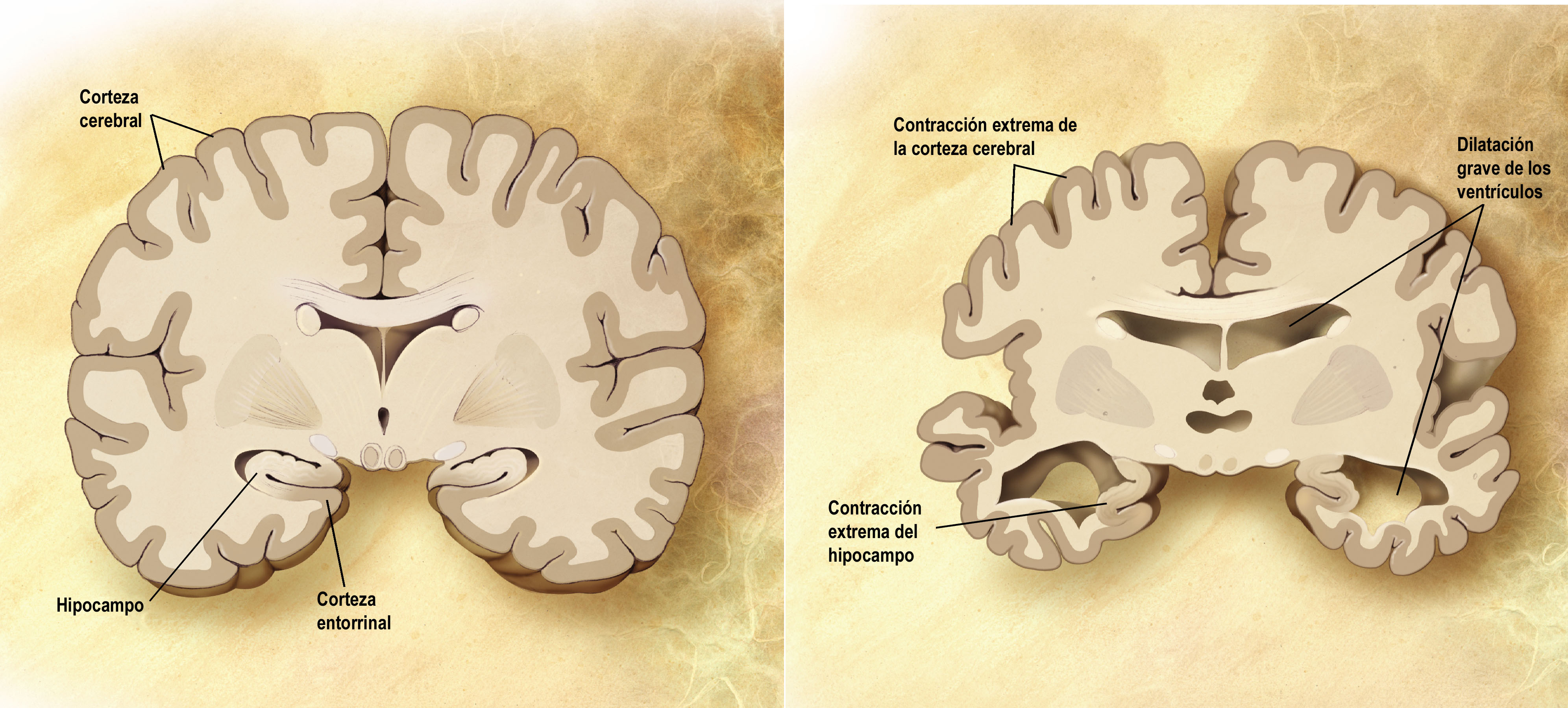 Corte frontal de un cerebro sano (izquierda) y con alzhéimer (derecha) | Fuente: Wikimedia Commons