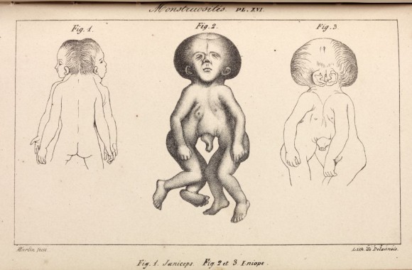 Monstruosidades. Ilustración de Histoire Générale et Particulière des Anomalies de l'Organisation (1832-7) de Saint Hilaire