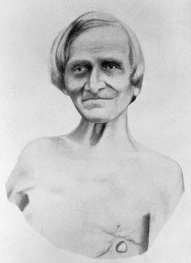 Retrato de Alexis St Martin ya anciano con su fístula en el costado izquierdo.
