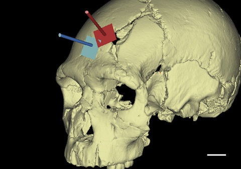 Imagen en la que se muestran los dos traumas del cráneo 17 y la distinta trayectoria de cada uno de los impactos. |Sala et al. (2015)