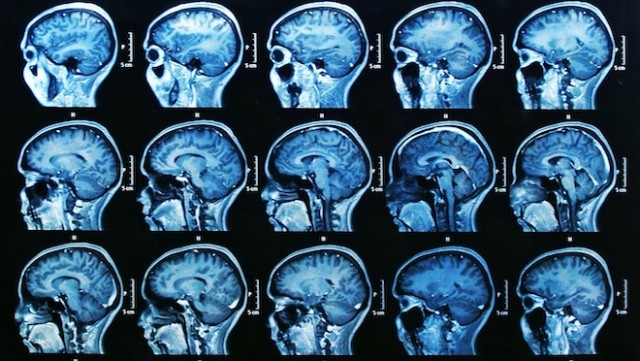 Resonancia magnética de un cerebro humano
