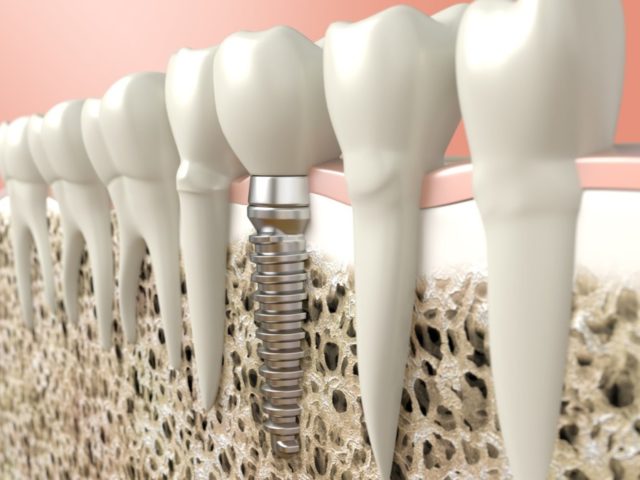 implantes-dentales-profilacticos