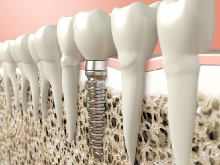 Implantes orales profilácticos