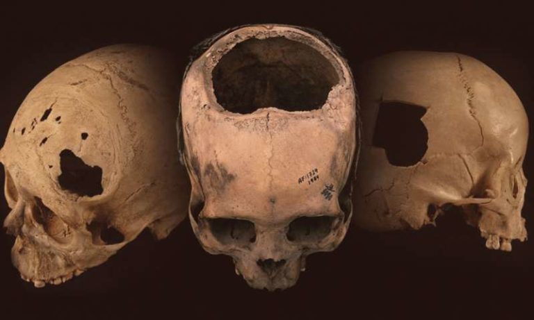 El arte de abrir cráneos: neurocirugía y trepanaciones durante el imperio inca