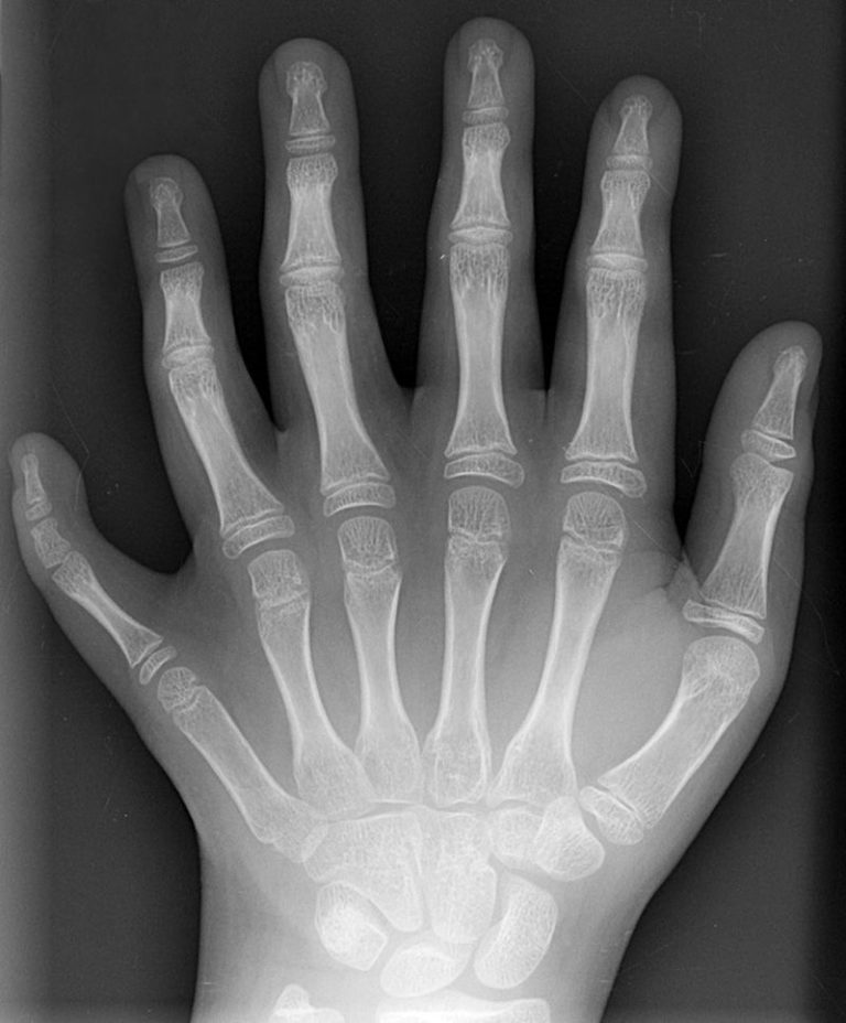 800px-Polydactyly_01_Lhand_AP