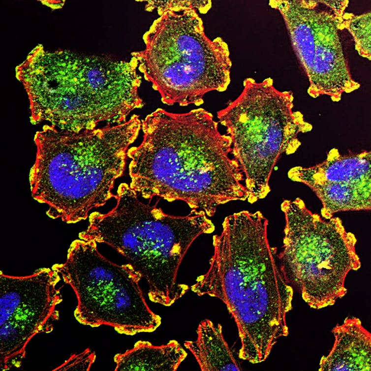 La senescencia celular: el gran desafío para entender y tratar el cáncer