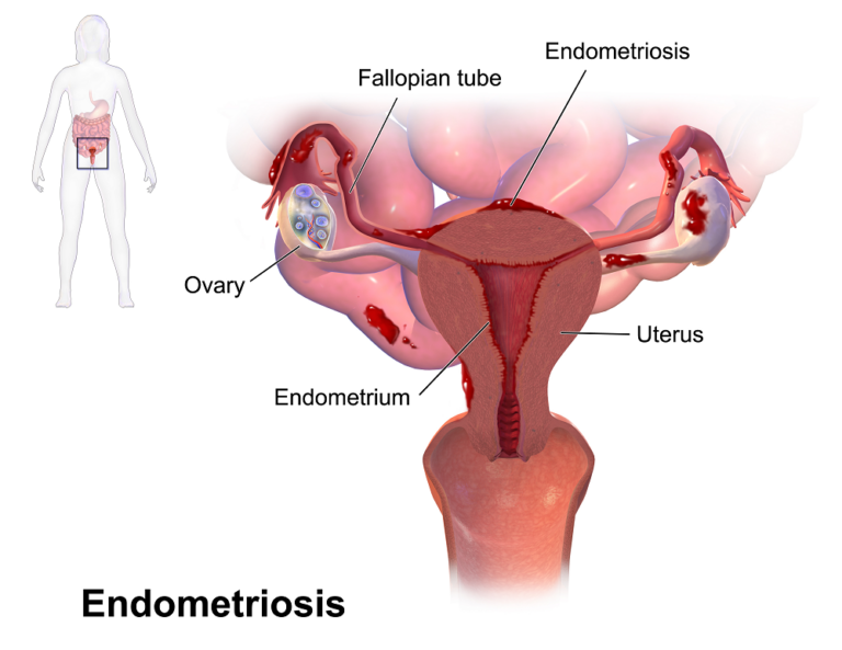 La carrera de obstáculos para el diagnóstico de la endometriosis