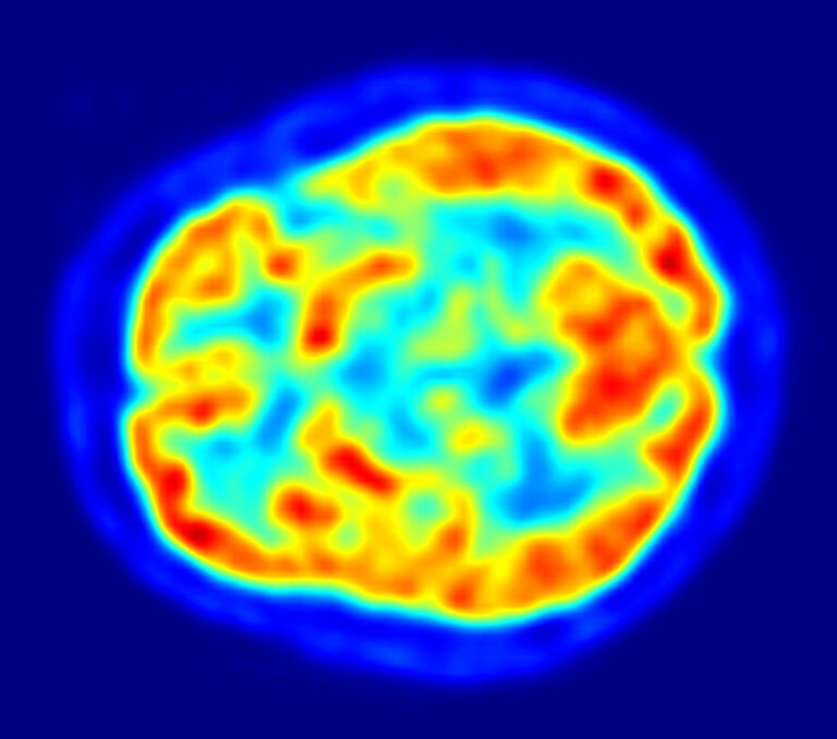 Alzhéimer, detección precoz con inteligencia artificial