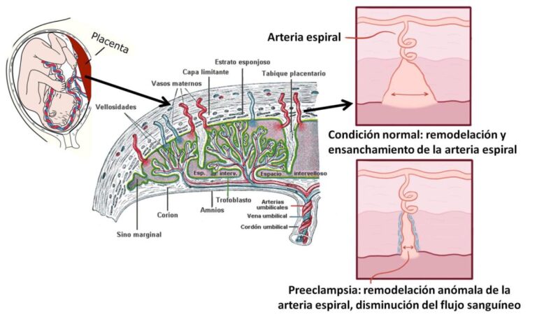 Nanopartículas lipídicas: una esperanza para tratar la preeclampsia