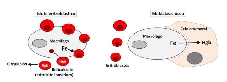 Metástasis ósea y anemia: el hierro es la clave