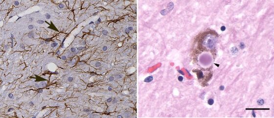 Zombosomas: mensajeros celulares que pueden propagar patologías neurodegenerativas