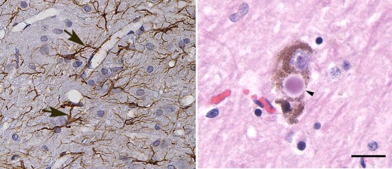 Zombosomas: mensajeros celulares que pueden propagar patologías neurodegenerativas
