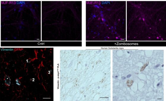 Zombosomas: mensajeros celulares que pueden propagar patologías neurodegenerativas