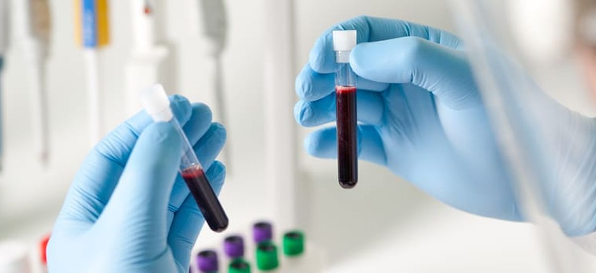 cáncer de páncreas