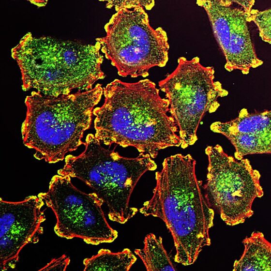 ¿Una vacuna contra el melanoma?
