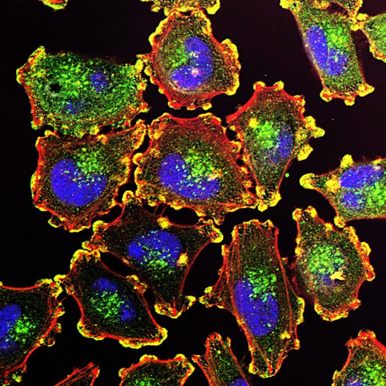 ¿Una vacuna contra el melanoma?